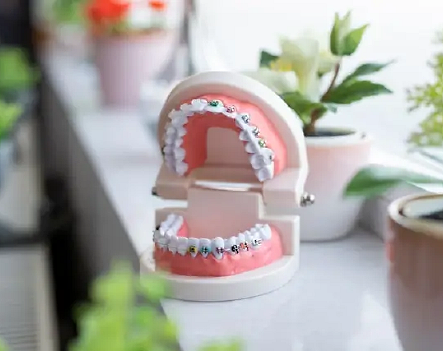 Dental Braces