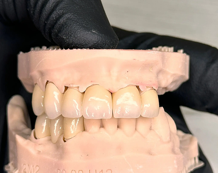 Zirconia dental crown