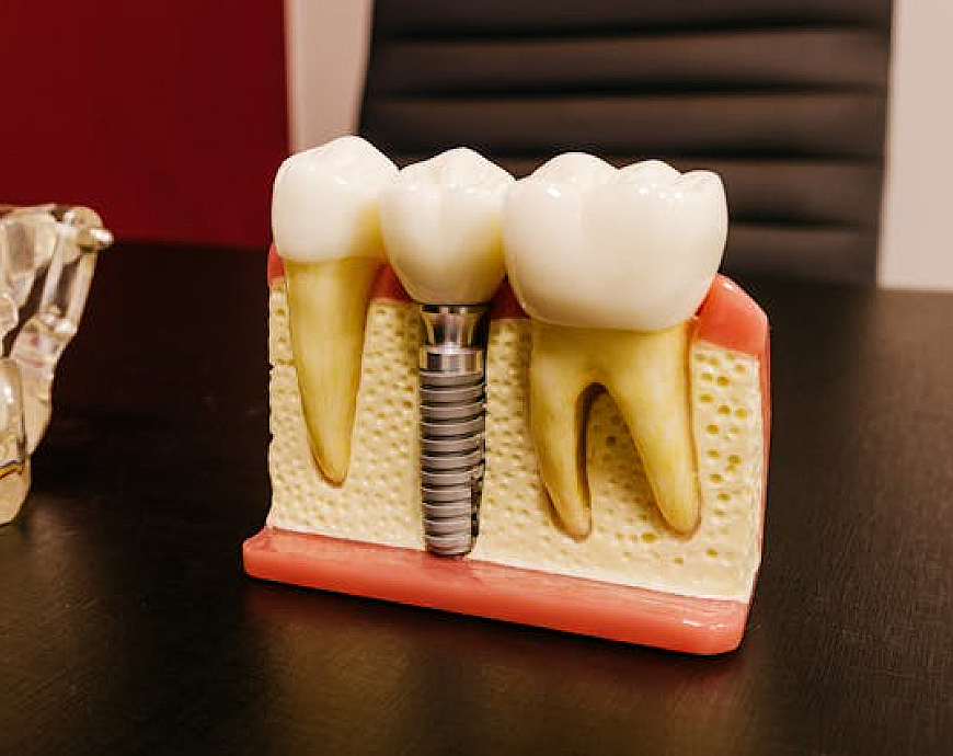 Implant dentar