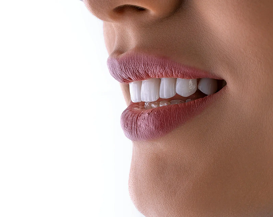 Dental veneers