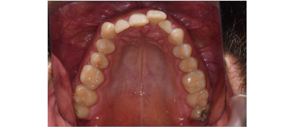 Rezultate tratament ortodontic cu aparat dentar metalic