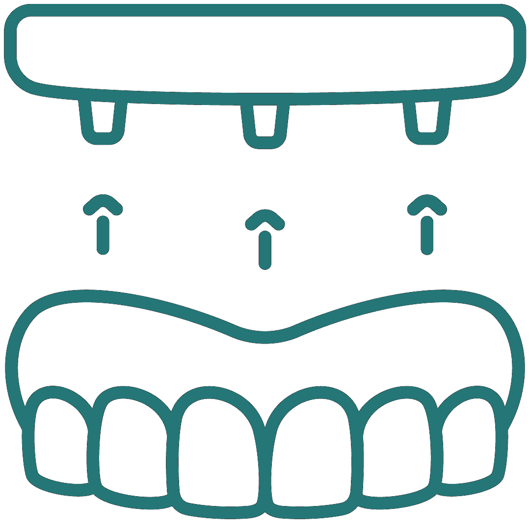 Fixed prosthesis on the implant